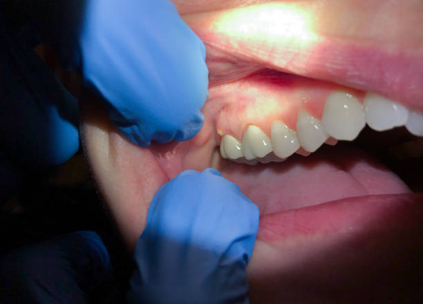 Best Emergency Root Canal Treatment in Prceton, IN