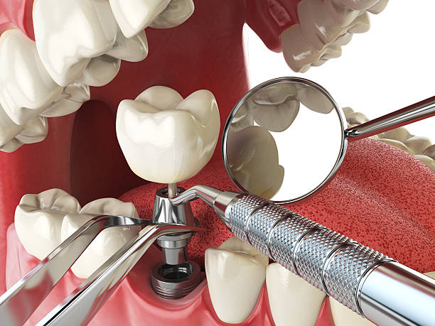 Best Emergency Treatment for Dental Infections or Abscesses in Prceton, IN